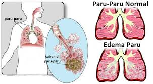 Illustration for article titled Apakah Penyakit Paru Paru Basah Dapat Menyebabkan Kematian